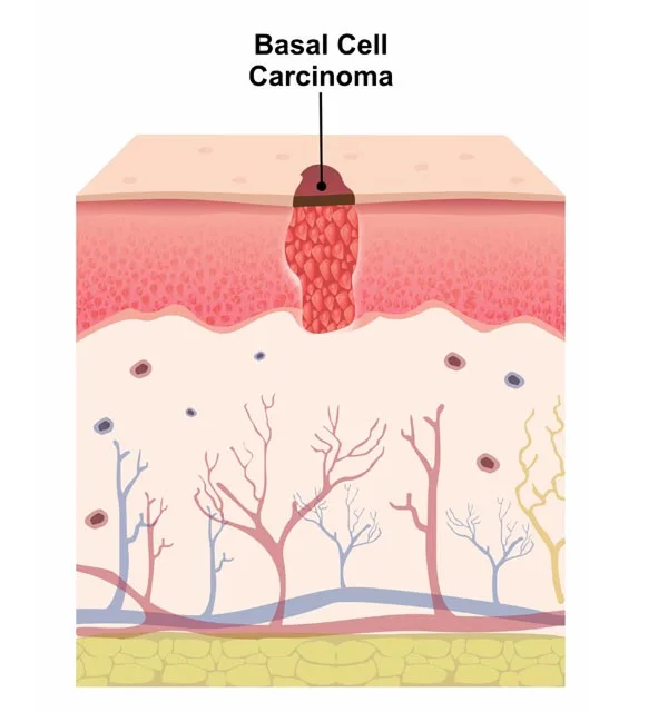 Basal Cell Carcinoma
