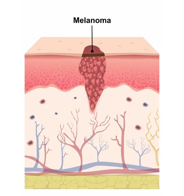 Malignant Melanoma