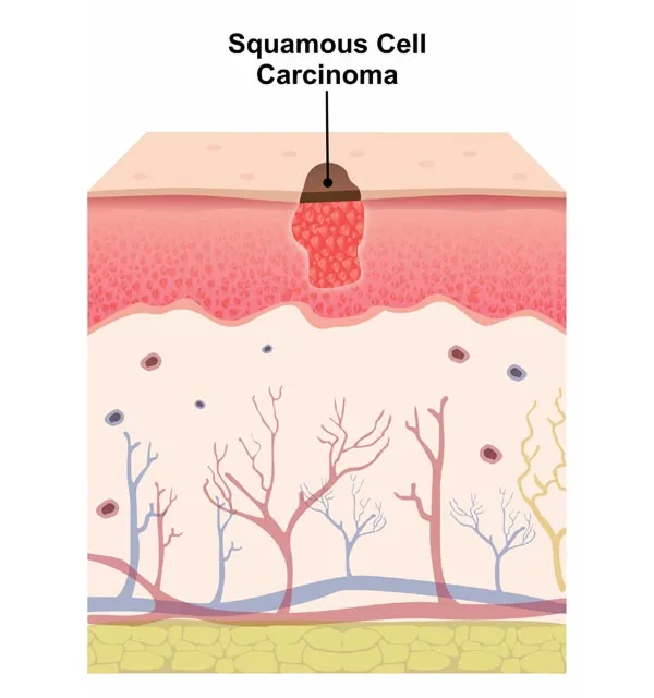 Squamous Cell Carcinoma (SCC)