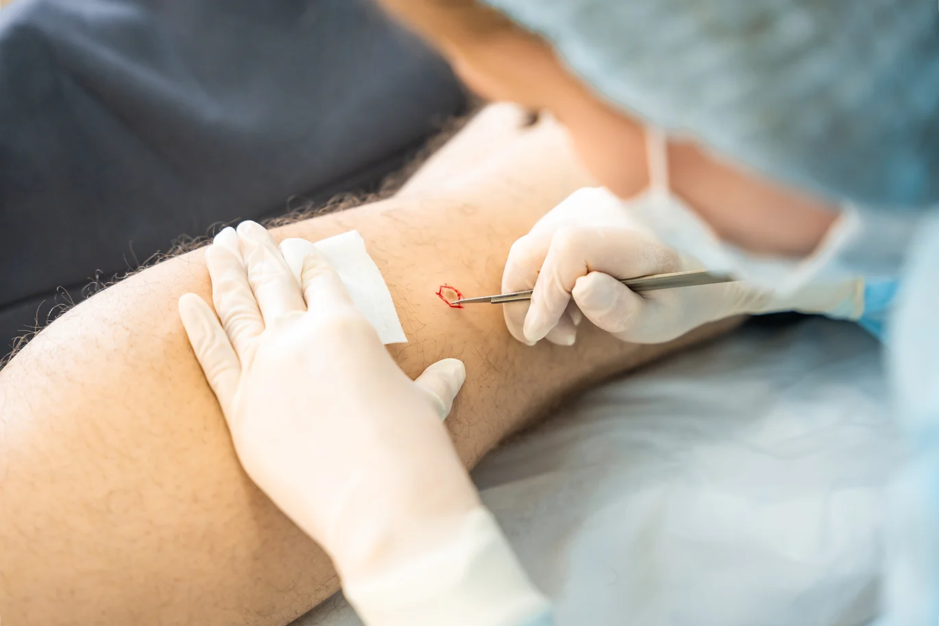 Cosmetic Mole Removal